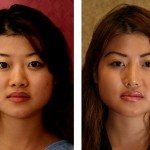 Rhinoplasty - Asian Before & After Patient #6394