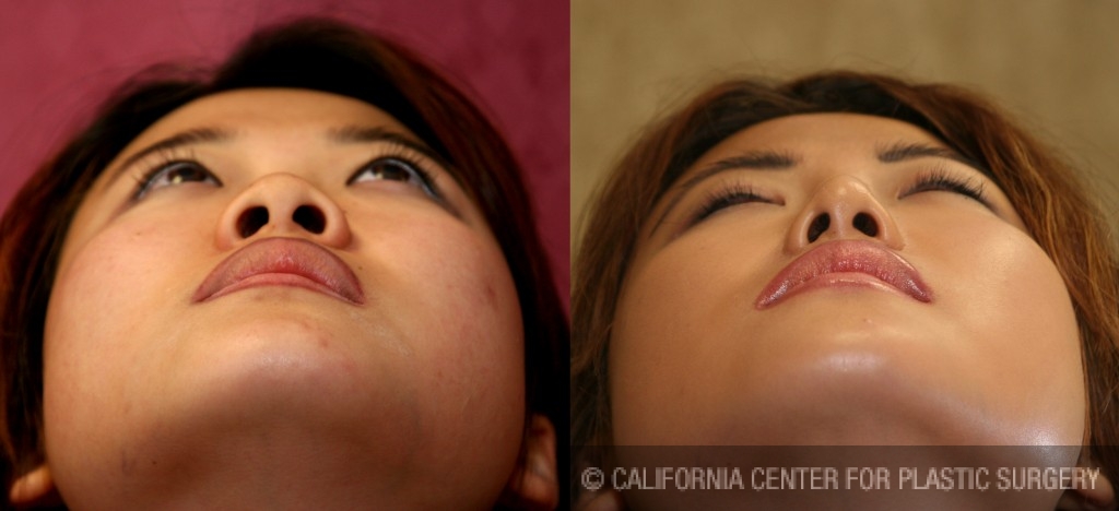 Rhinoplasty - Asian Before & After Patient #6394