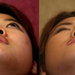 Rhinoplasty - Asian Before & After Patient #6394