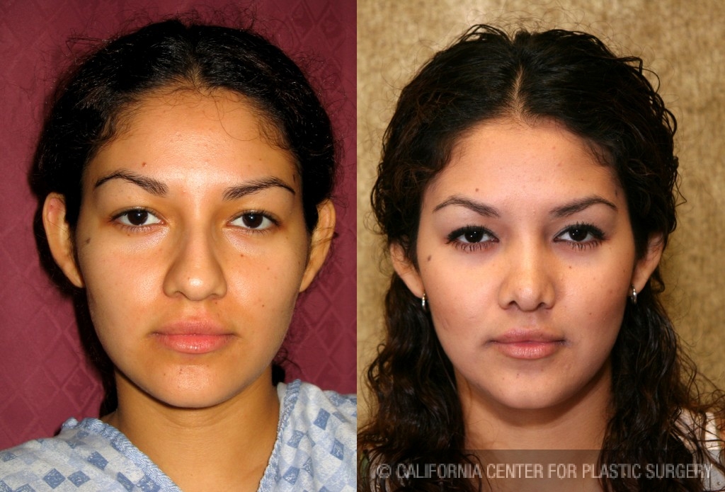 Rhinoplasty - Hispanic Before & After Patient #6292