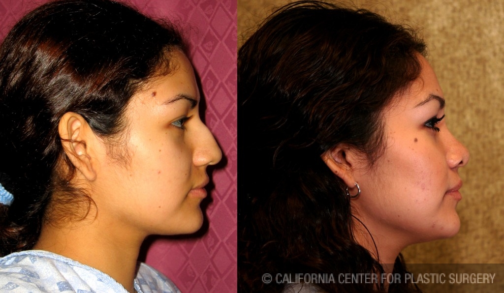 Rhinoplasty - Hispanic Before & After Patient #6292