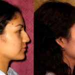 Rhinoplasty - Hispanic Before & After Patient #6292