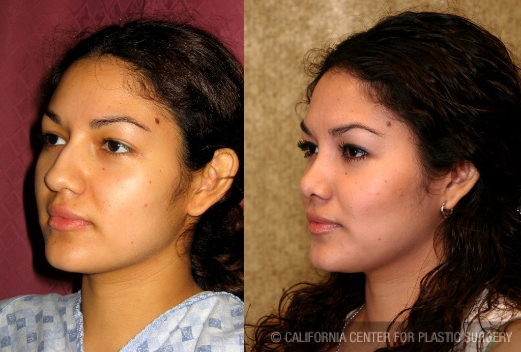 Rhinoplasty - Hispanic Before & After Patient #6292