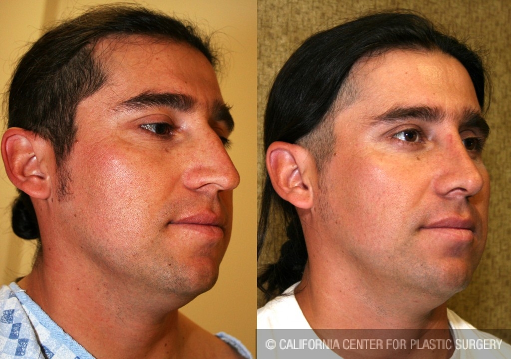 Male Rhinoplasty Before & After Patient #6405