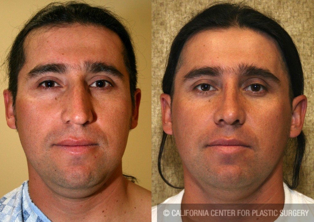 Male Rhinoplasty Before & After Patient #6405