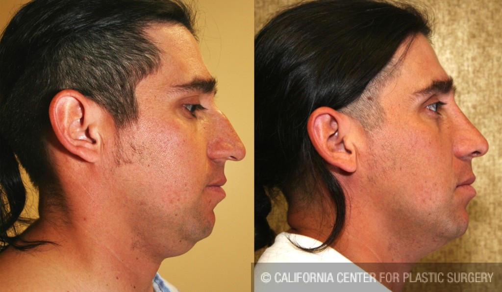 Male Rhinoplasty Before & After Patient #6405