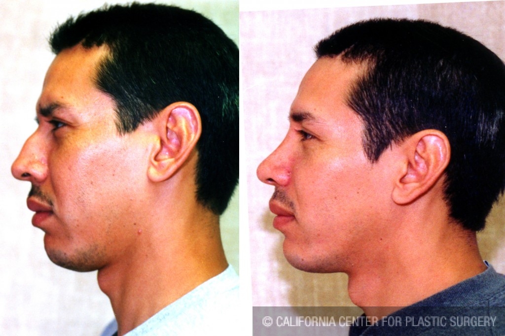 Male Rhinoplasty Before & After Patient #6401