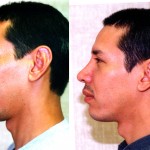 Male Rhinoplasty Before & After Patient #6401