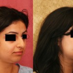 Rhinoplasty - Middle Eastern Before & After Patient #6334