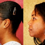 Rhinoplasty - African American Before & After Patient #6300