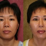 Rhinoplasty - Asian Before & After Patient #6368