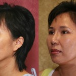 Rhinoplasty - Asian Before & After Patient #6368