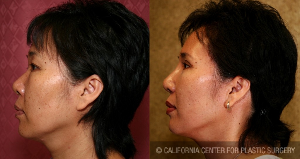 Rhinoplasty - Asian Before & After Patient #6368