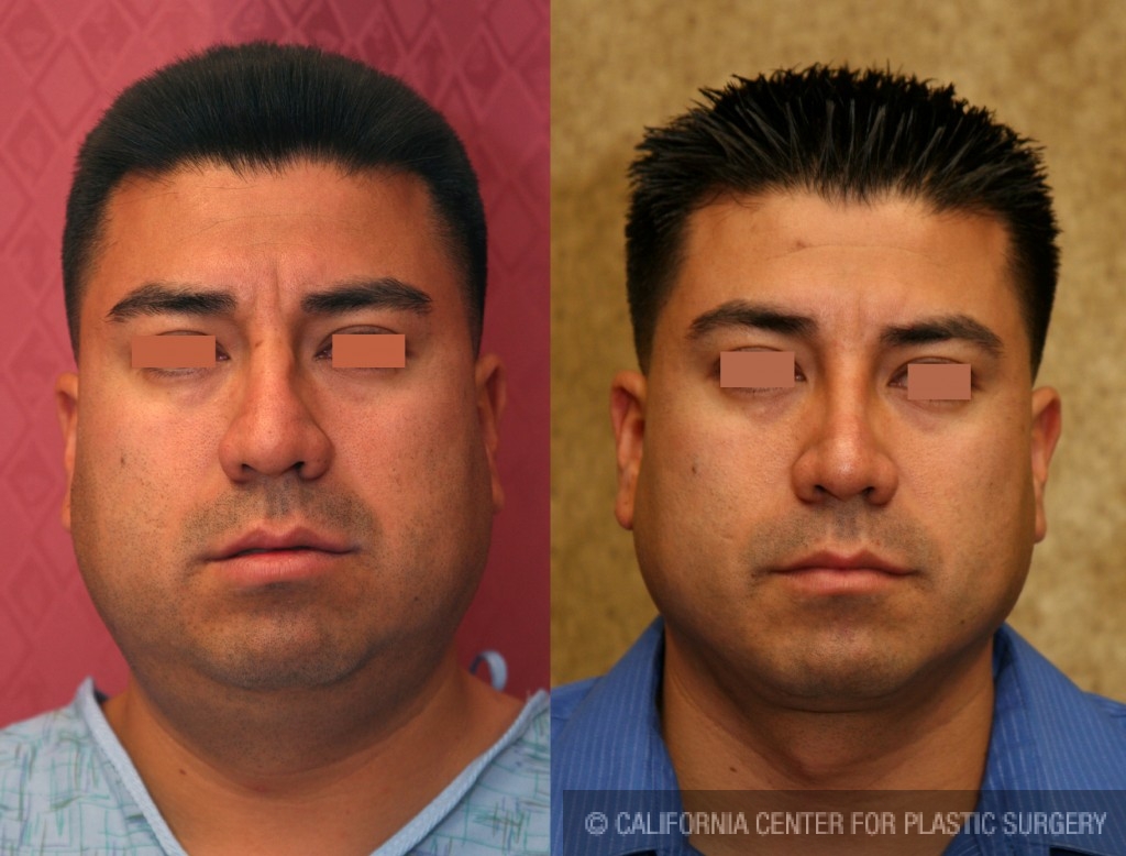 Male Rhinoplasty Before & After Patient #6418