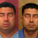 Male Rhinoplasty Before & After Patient #6418