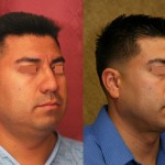 Male Rhinoplasty Before & After Patient #6418