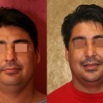 Male Rhinoplasty Before & After Patient #6413