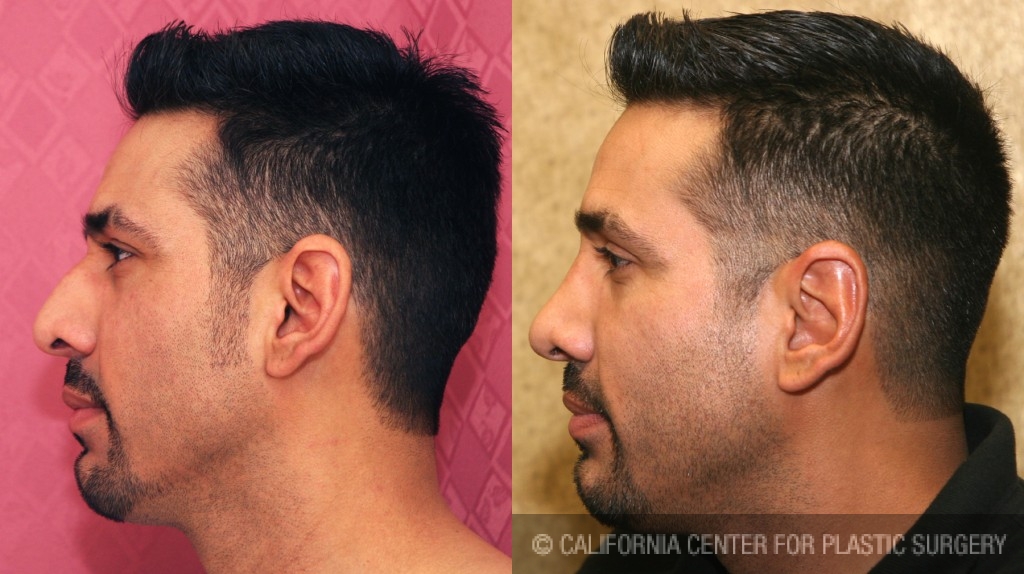 Male Rhinoplasty Before & After Patient #6431