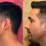 Male Rhinoplasty Before & After Patient #6431