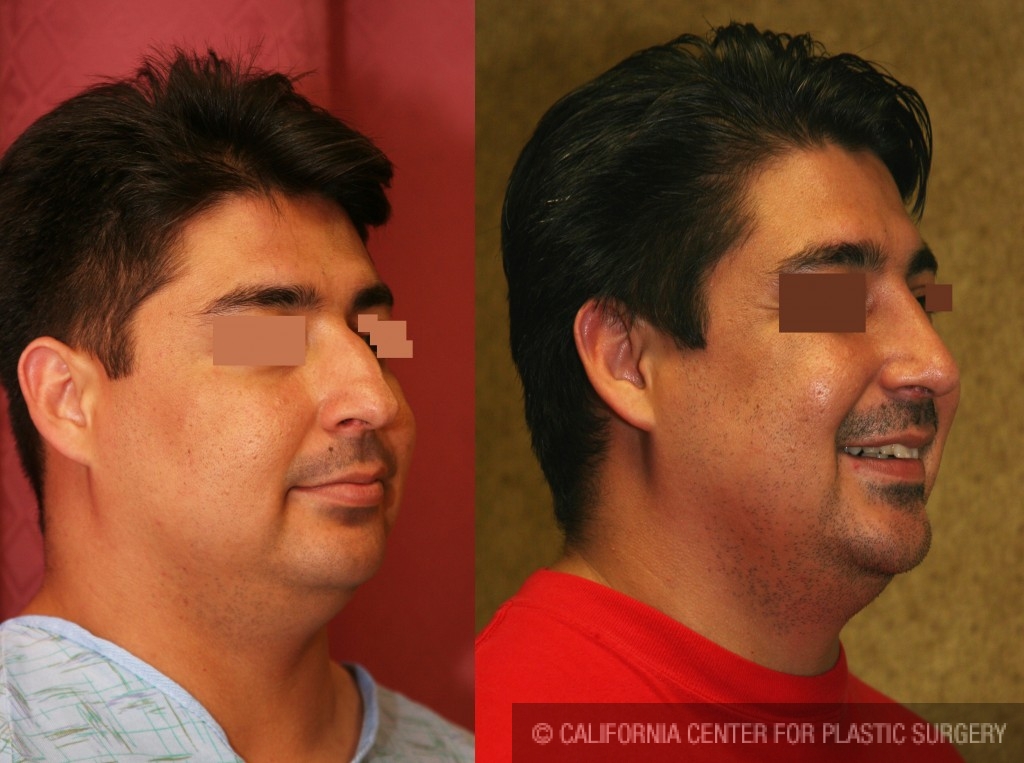 Male Rhinoplasty Before & After Patient #6413