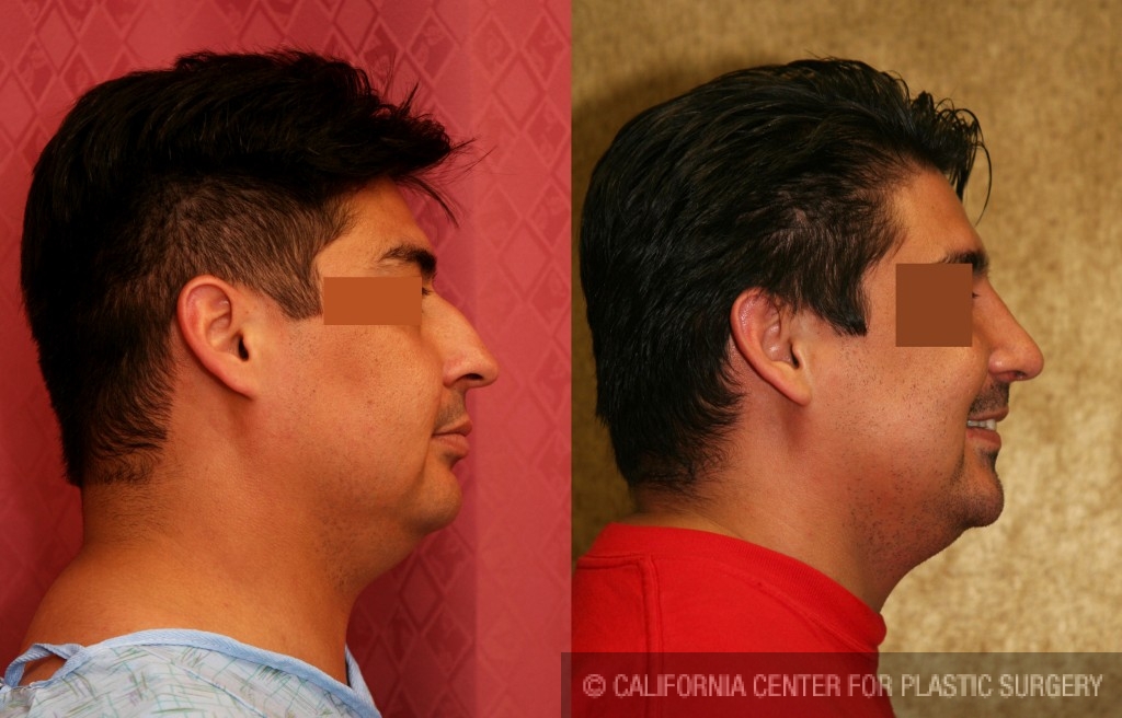 Male Rhinoplasty Before & After Patient #6413