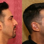 Male Rhinoplasty Before & After Patient #6431