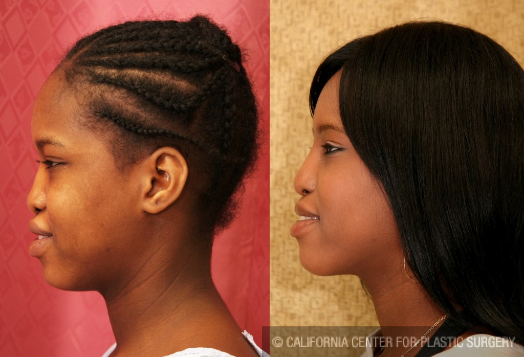 Rhinoplasty - African American Before & After Patient #6319