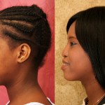 Rhinoplasty - African American Before & After Patient #6319