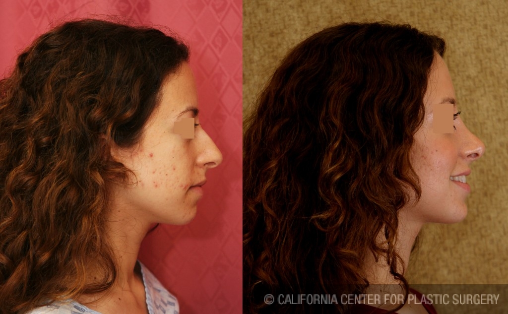 Rhinoplasty - Caucasian Before & After Patient #6243