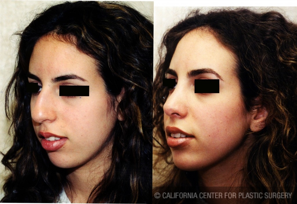 Rhinoplasty - Middle Eastern Before & After Patient #6325