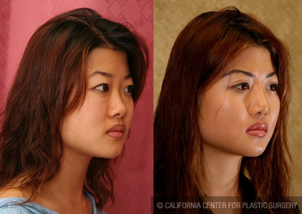 Patient #6394 Asian Rhinoplasty Before and After Photos Beverly Hills -  Plastic Surgery Gallery Los Angeles, CA - Dr. Sean Younai