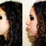 Rhinoplasty - Middle Eastern Before & After Patient #6325