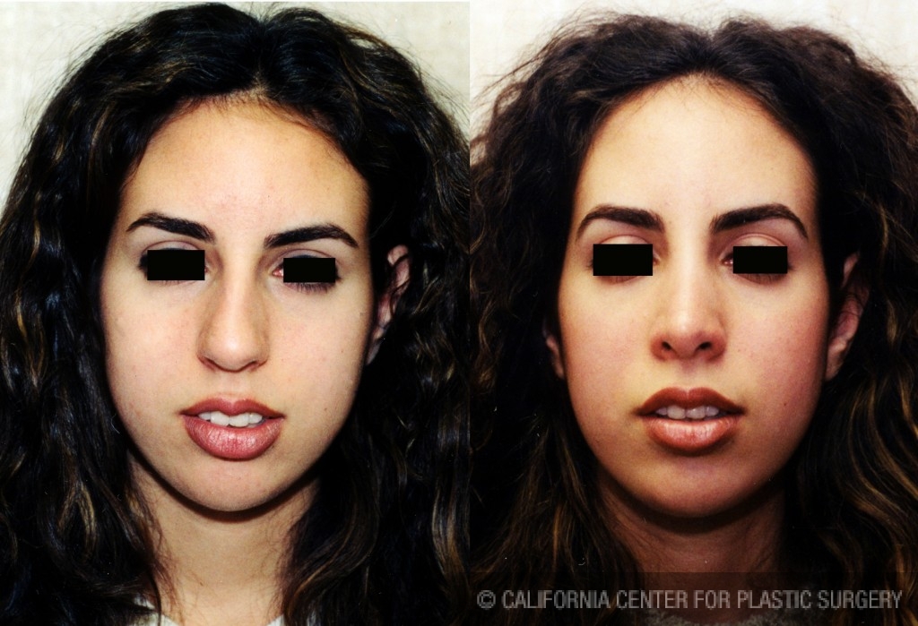 Rhinoplasty - Middle Eastern Before & After Patient #6325