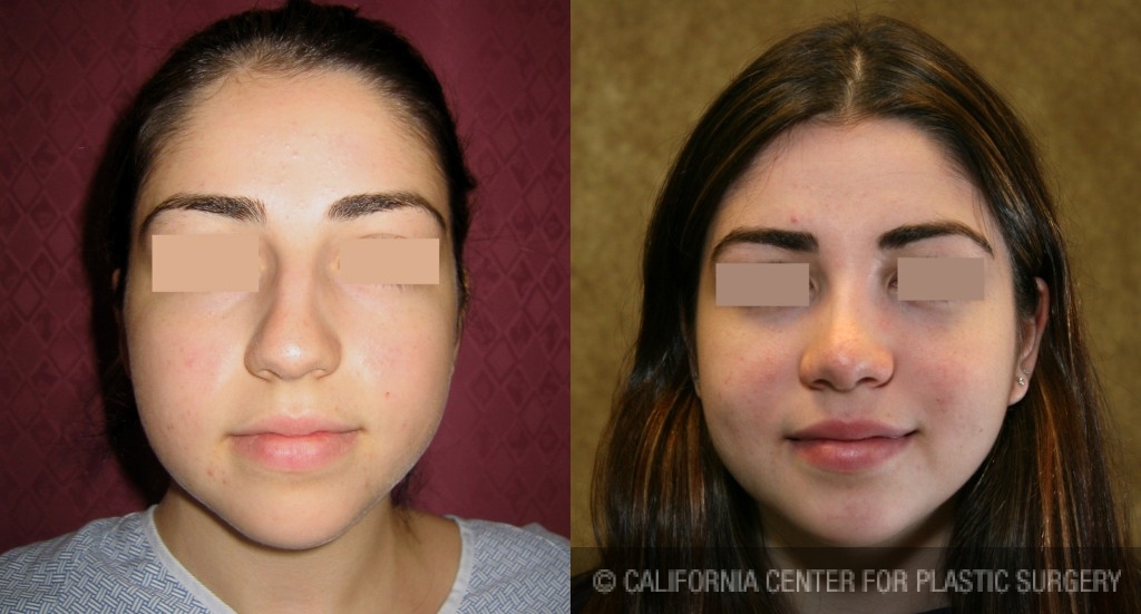 Rhinoplasty - Middle Eastern Before & After Patient #6339