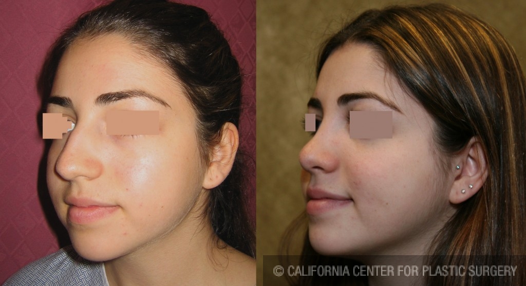 Rhinoplasty - Middle Eastern Before & After Patient #6339