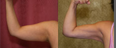 Liposuction Arms Before & After Patient #9484