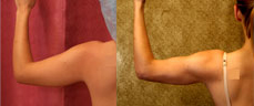 Liposuction Arms Before & After Patient #9484