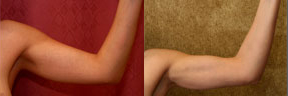 Liposuction Arms Before & After Patient #9484