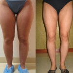 Liposuction Thighs Before & After Patient #9439