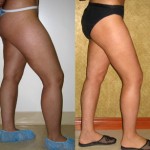 Liposuction Thighs Before & After Patient #9439