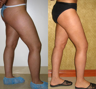 Liposuction Thighs Before & After Patient #9439