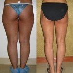 Liposuction Thighs Before & After Patient #9439