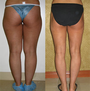 Liposuction Thighs Before & After Patient #9439