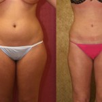 Liposuction Thighs Before & After Patient #9446