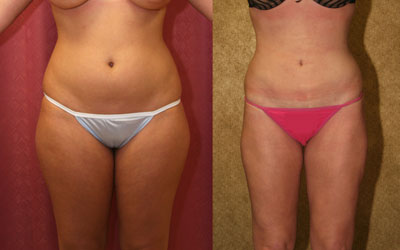 Liposuction Thighs Before & After Patient #9446