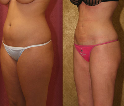 Liposuction Thighs Before & After Patient #9446