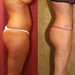 Liposuction Thighs Before & After Patient #9446