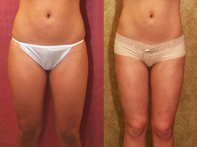 Liposuction Thighs Before & After Patient #9451