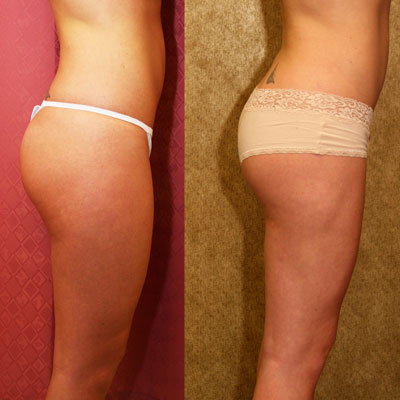 Liposuction Thighs Before & After Patient #9451