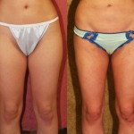 Liposuction Thighs Before & After Patient #9455